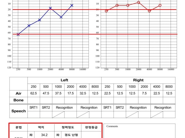 좌측 경도난청과 이명, 집중 치료 1달 만에 정상 청력 회복