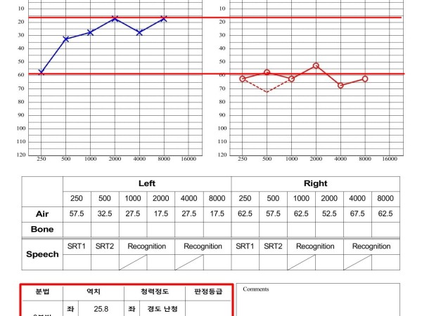 우측 중고도 난청과 좌측 경도난청, 집중 치료 후 청력 개선 사례