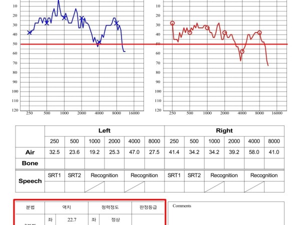 양측 난청과 박동성 이명, 집중 치료 후 청력 개선 및 수치 호전