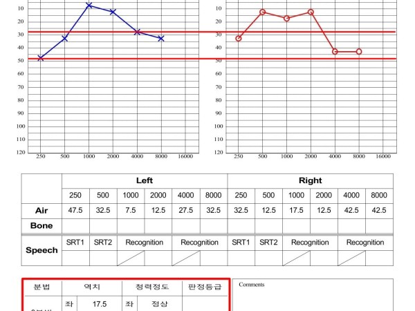 만성 이명과 귀 먹먹함, 집중 치료 후 증상 완화 및 정상 청력 유지