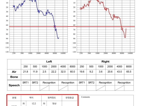 만성 피로와 이명·어지럼증, 집중 치료 후 청력 개선 사례