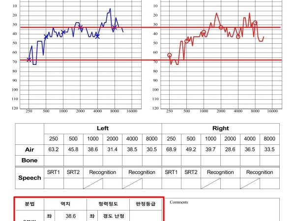 소아 양측 이명과 난청, 집중 치료 후 증상 개선 사례