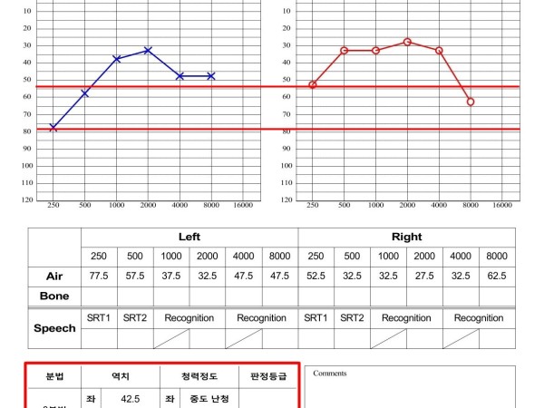 양측 이명과 난청, 집중 치료 1개월여 만에 정상 청력 회복