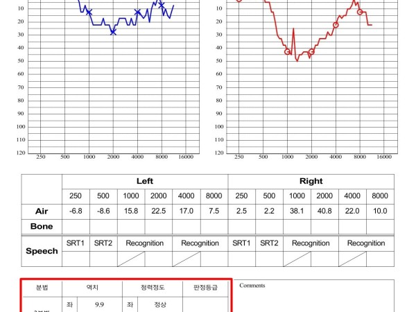 우측 돌발성 난청과 이명, 집중 치료 후 정상 청력 회복