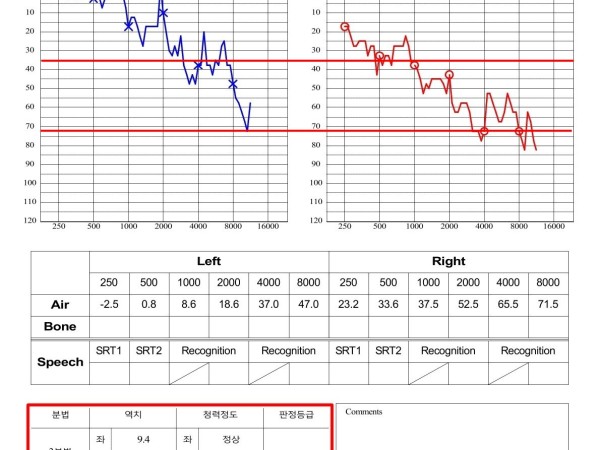 우측 중도난청과 이명, 집중 치료 후 정상 청력 회복