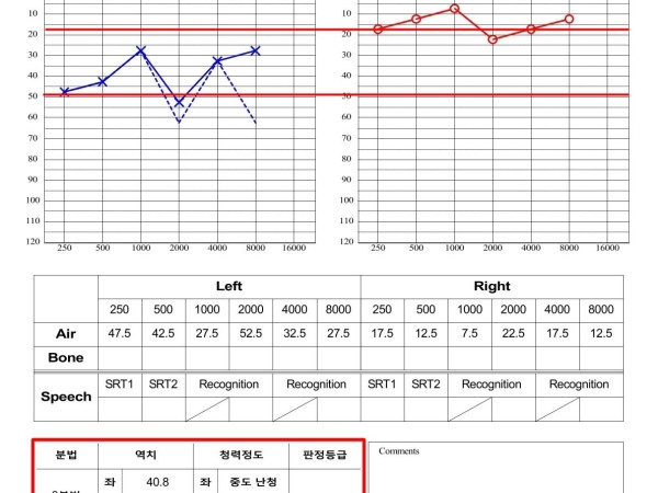24시간 이명과 좌측 난청, 집중 치료 1개월 만에 청력검사상 정상 회복
