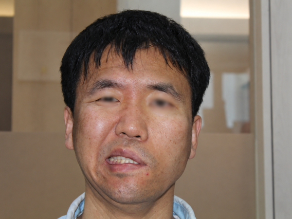 청각예민 동반한 안면마비, 대학병원 치료 후 통합한방 치료로 마비 개선