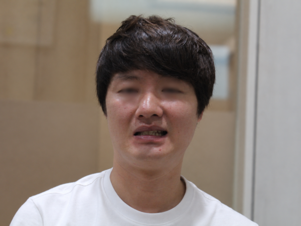 미각 상실 동반한 완전마비, 신경 복구 한방 집중 치료로 빠른 증상 개선
