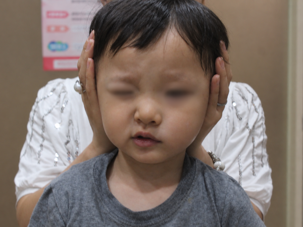 급성 완전마비 소아 환자, 3개월 집중 치료 후 일상 표정 회복