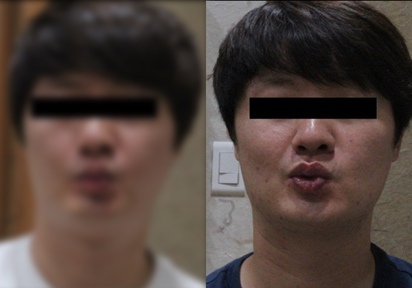구안와사 치료 후 좌우 대칭이 회복된 모습