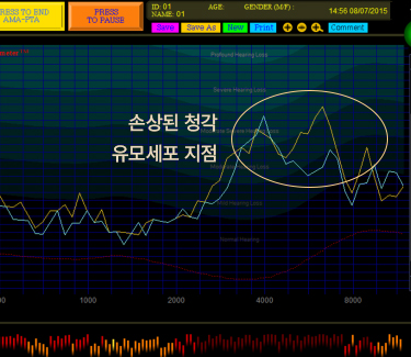 MTM 이명도 검사·미세청력검사
