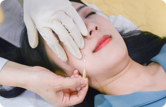 매선 치료