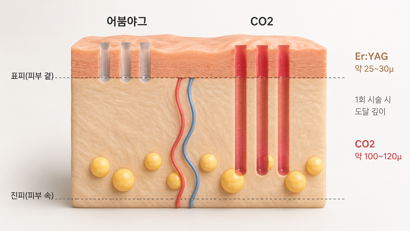 어븀야그 레이저와 CO2 레이저의 피부 도달 깊이 비교